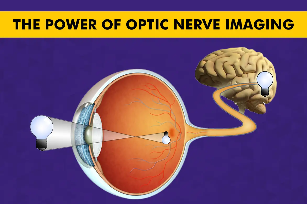 Optic Nerve Imaging in India: Types, Benefits, and Cost