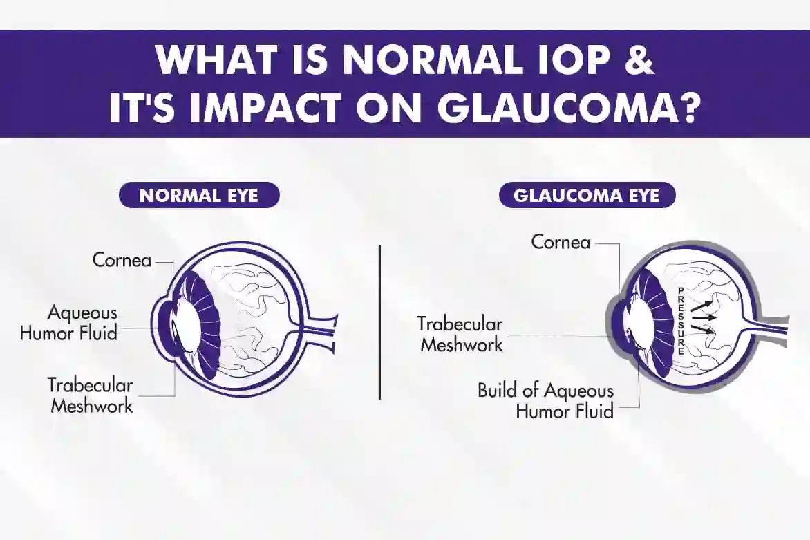 Normal Eye Pressure (IOP): Range, Risks, Diagnosis and Care