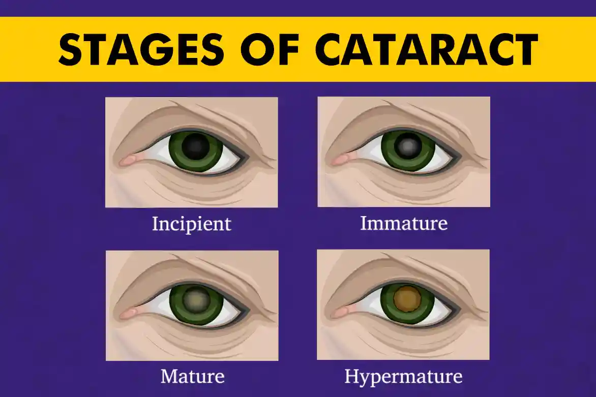 Cataract Grading - Types, Chart & Classification Explained