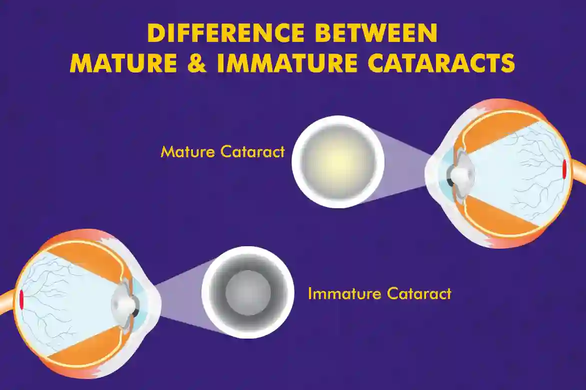Mature vs Immature Cataract - Understanding the Differences