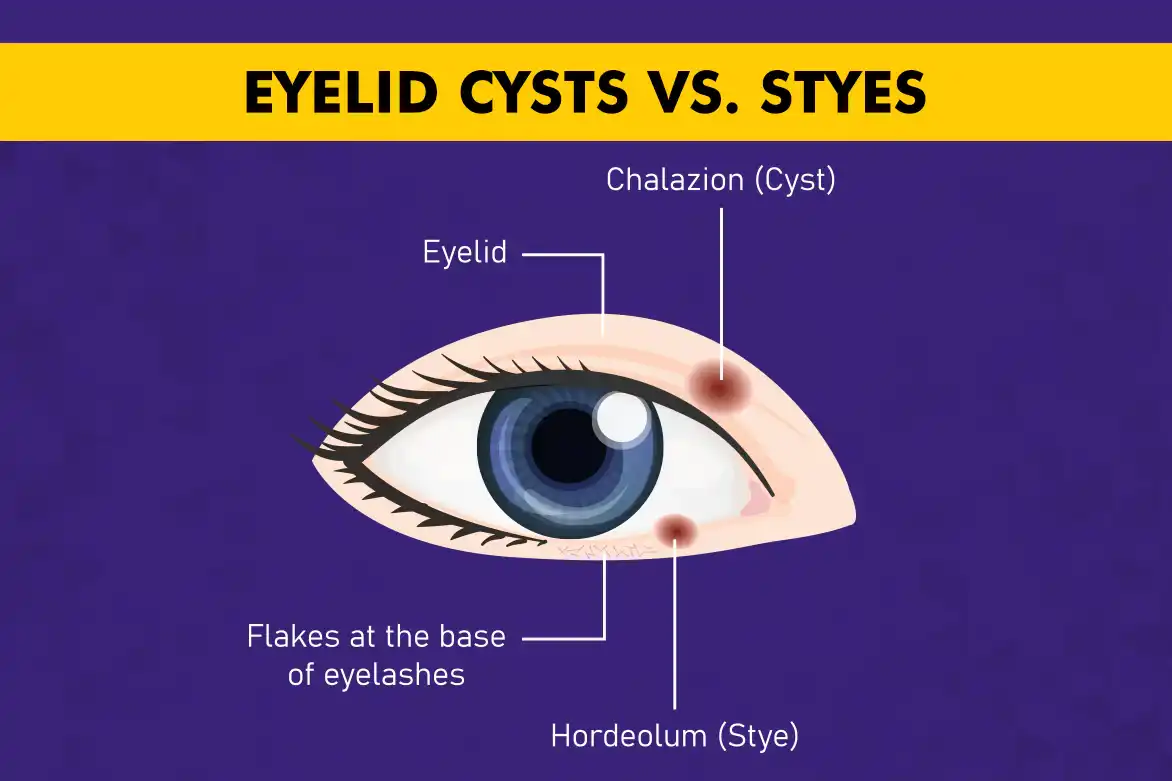 Eyelid Cyst vs Stye - Key Differences, Causes and Treatment
