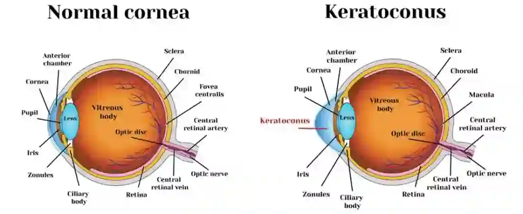 What is Corneal Disease: Symptoms, Facts and More