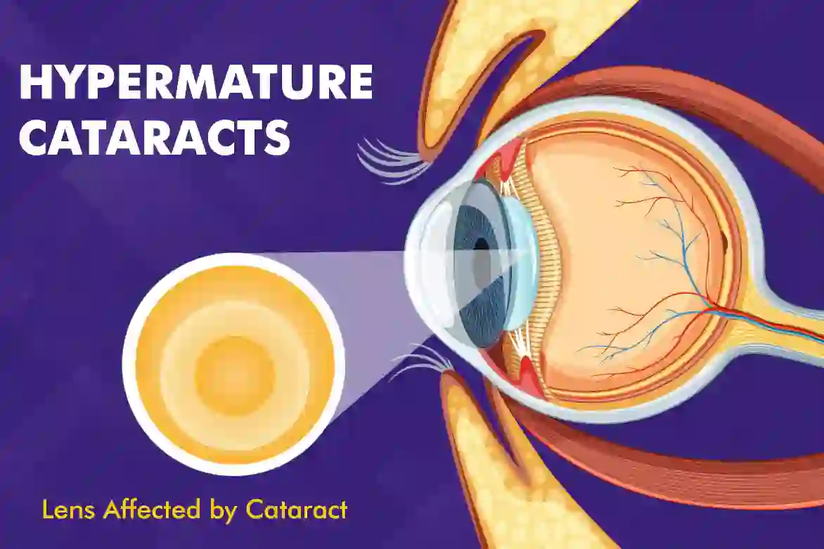 Hypermature Cataracts: Causes, Types, Symptoms, and Treatments