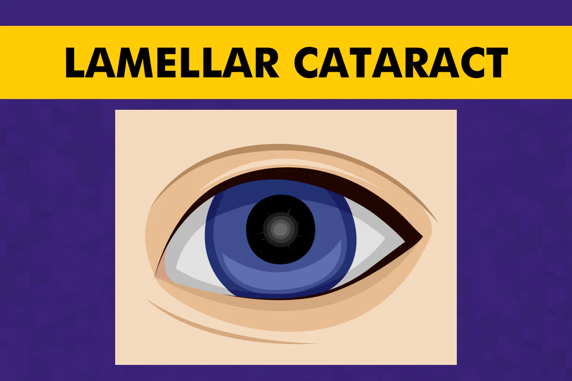 Lamellar Cataract (Zonular): Causes, Symptoms and Surgery