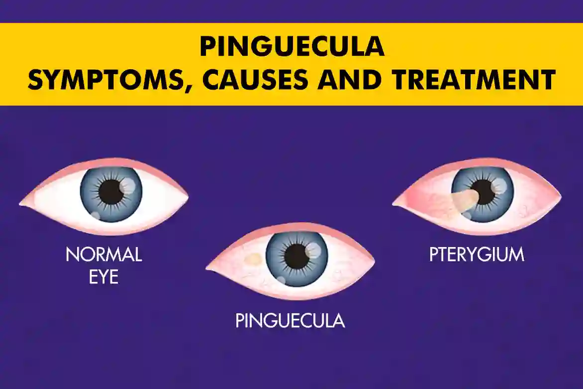 Pinguecula Eye Condition - Symptoms, Causes and Treatment