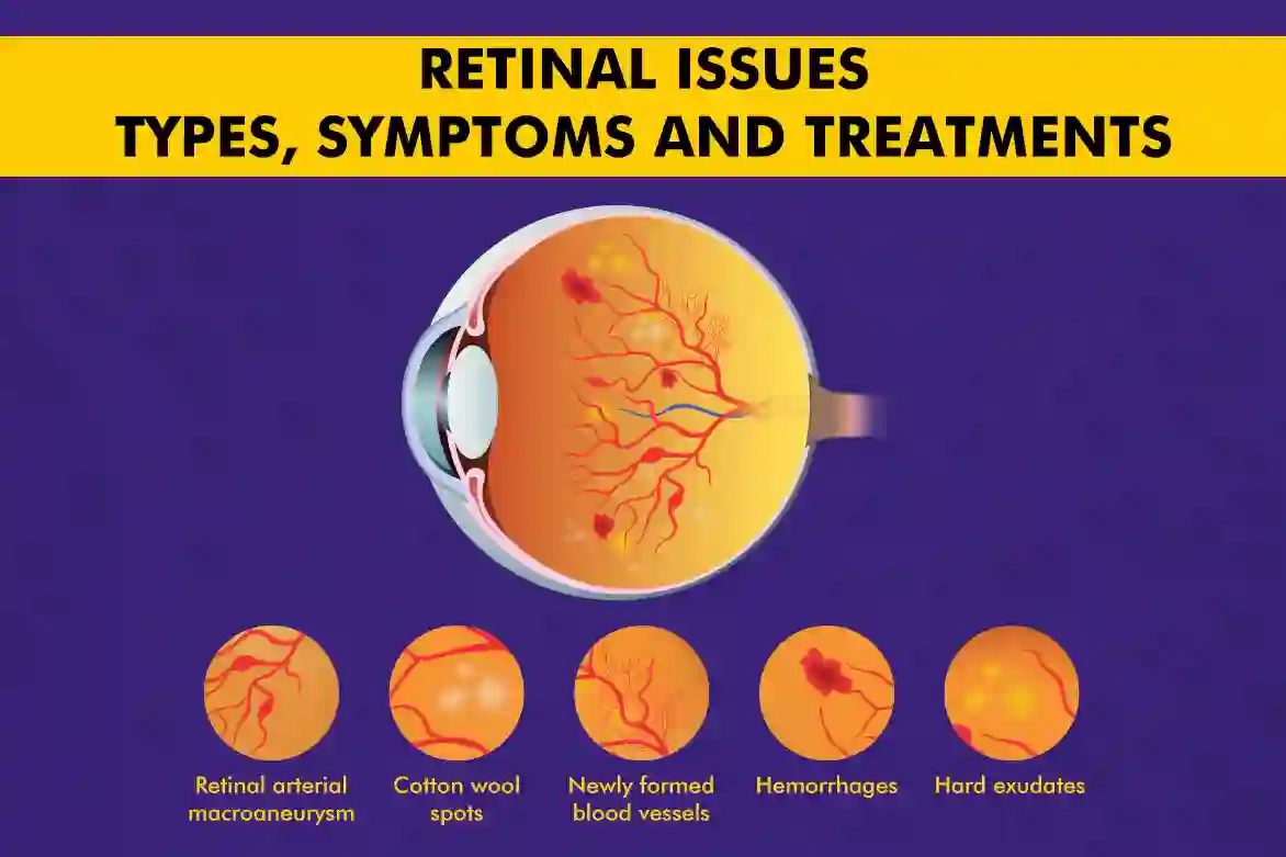 Retinal Diseases - Types, Symptoms and Treatments