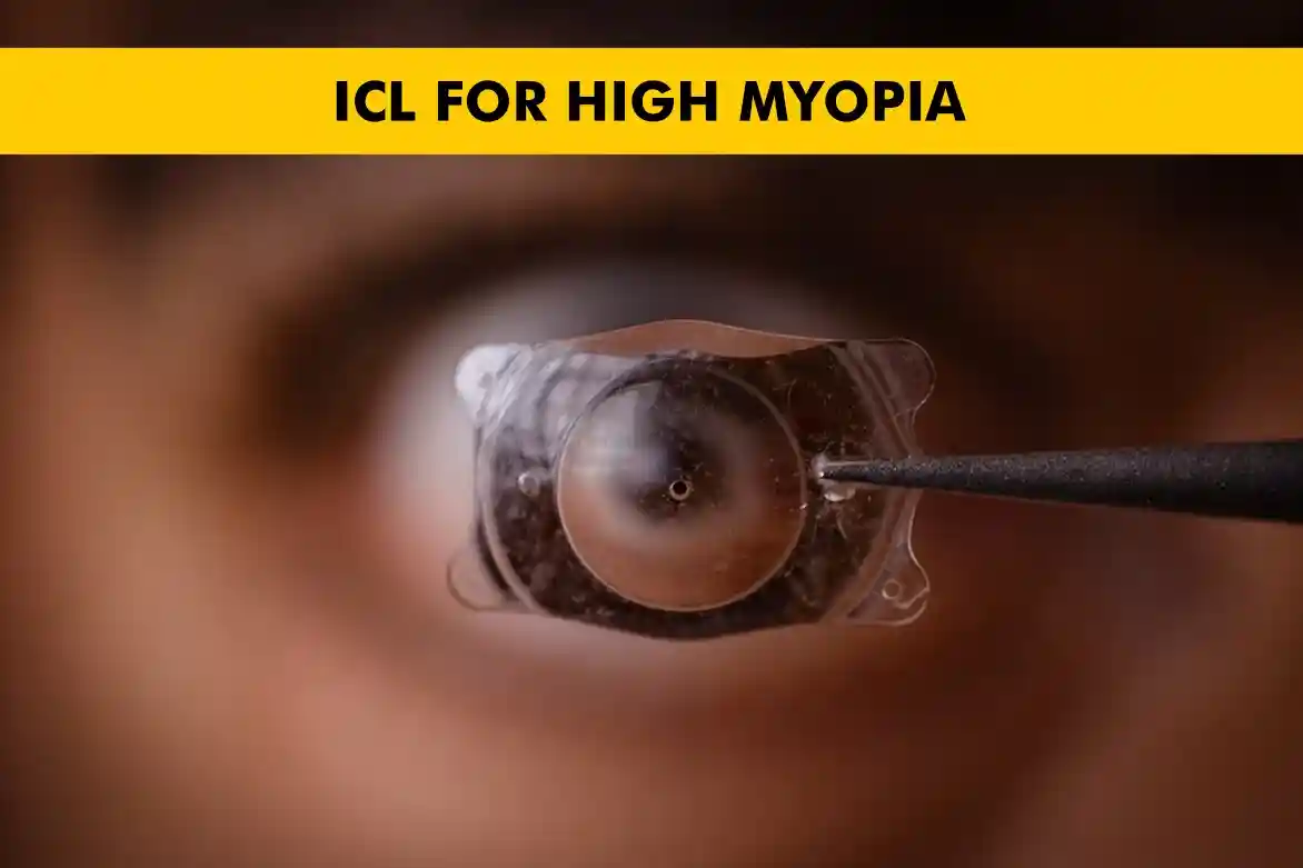 ICL Surgery for High Myopia: Benefits, Cost & Recovery