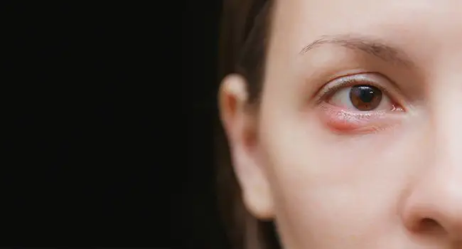 Chalazion (Eyelid Lump): Causes, Symptoms & Treatment