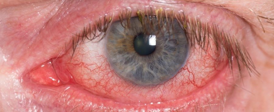 Myopia, The Silent Crisis In Children’s Vision