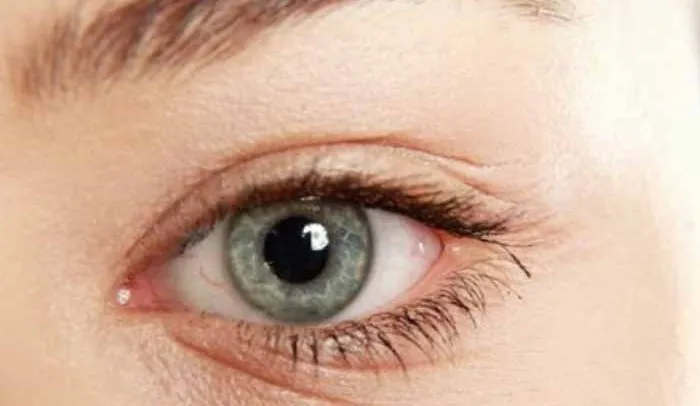 Myopia, The Silent Crisis In Children’s Vision