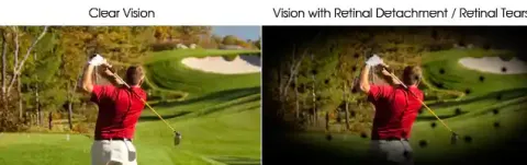 Retinal Detachment ? Cause & Cure