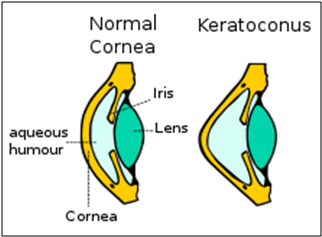 Understanding Keratoconus