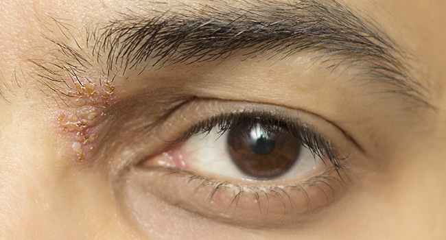 What are Shingles in the Eye?