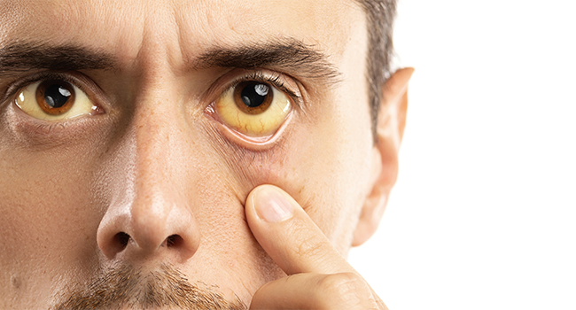 Yellow Eyes – Causes, Symptoms & Treatments