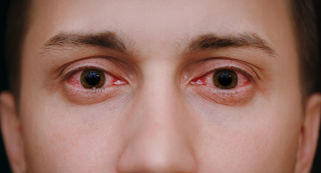 Why do you get red, irritated eyes after swimming?