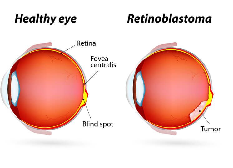 World Retinoblastoma Awareness