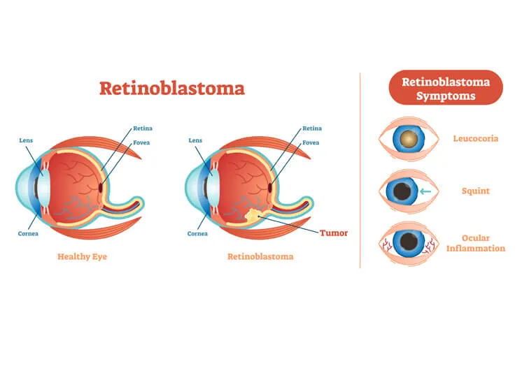 Awareness programmes on retinoblastoma