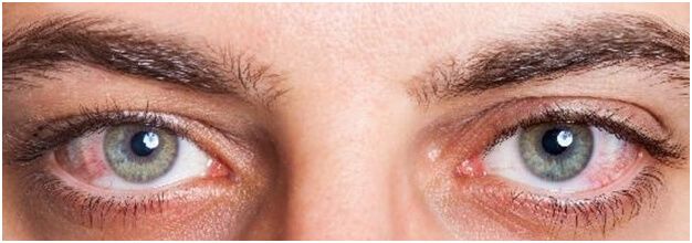 Could Fasting cause Dry Eyes?