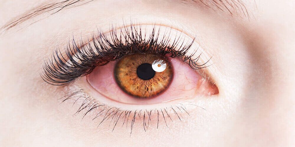 What causes Bloodshot Eyes and How to Treat Red Eyes?