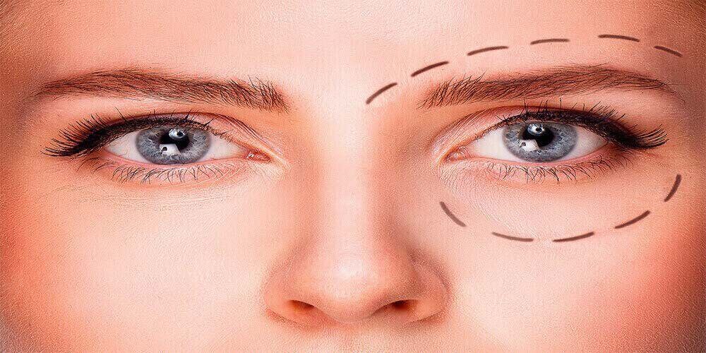 5 Things to Know About Eyelid Surgery