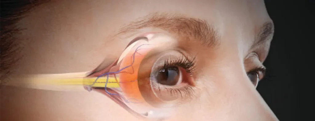 A Look into the Latest Developments of Glaucoma Treatment