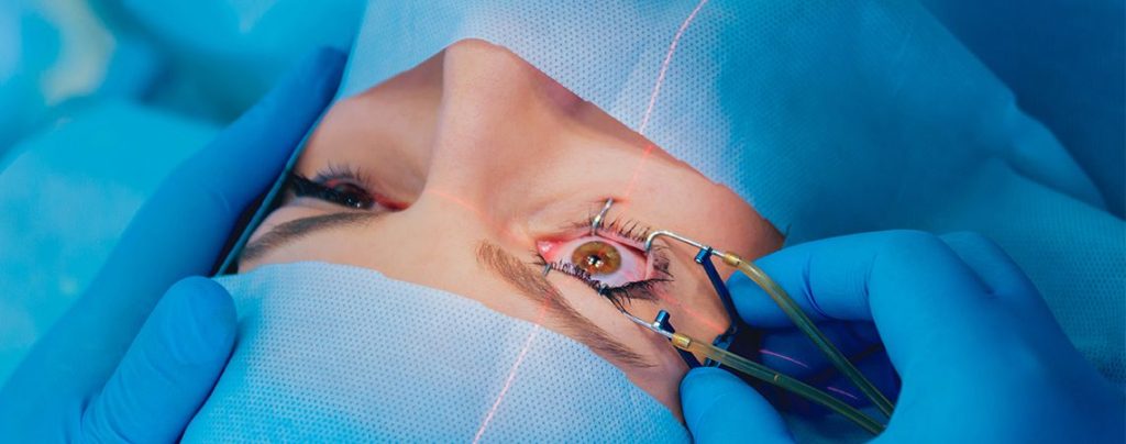 Everything You Should Know About LASIK Eye Surgery