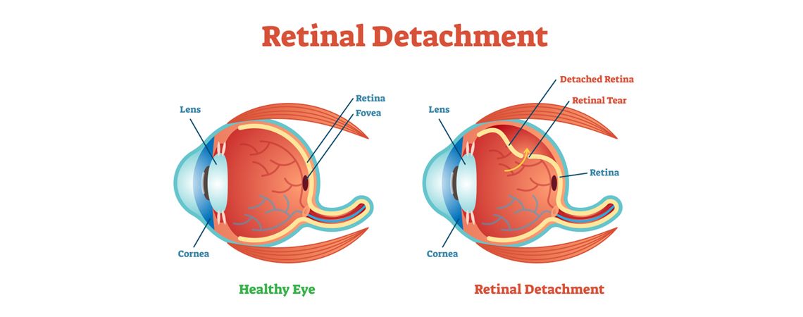 retinal detachment vision