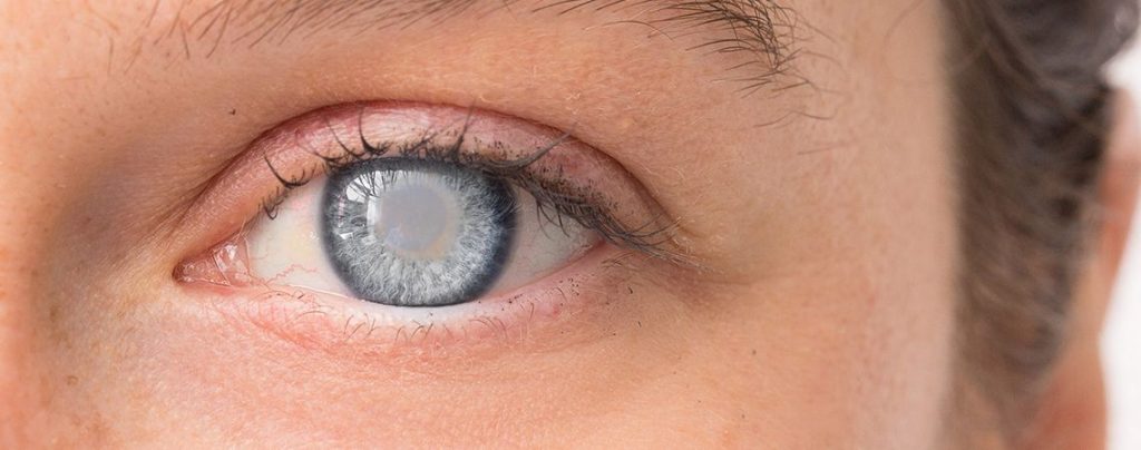 Cataract – Everything You Should Know About it