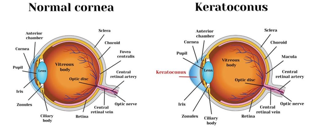 Facts about Cornea and Corneal Diseases