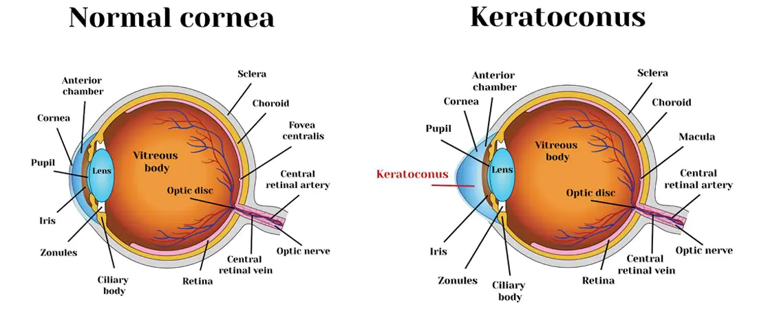 Facts about Cornea and Corneal Diseases