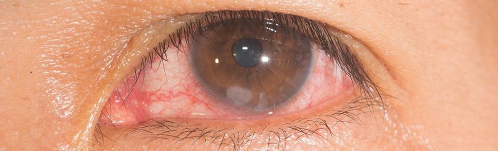 Story of wearing Contact Lenses and the risk of corneal ulcer