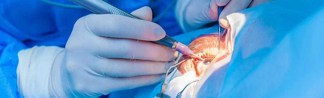 The Peripheral Aspects of Vitreoretinal Surgery