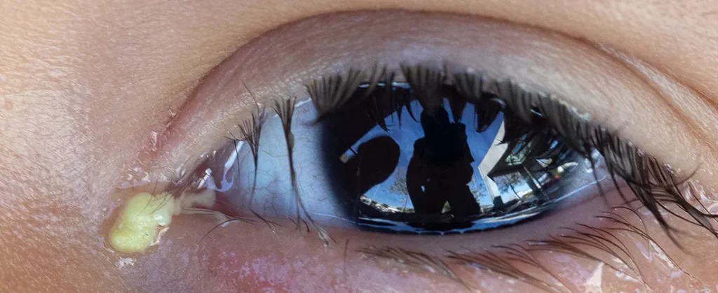 The Phenomenon of Eye Discharge and associated Eye Problems
