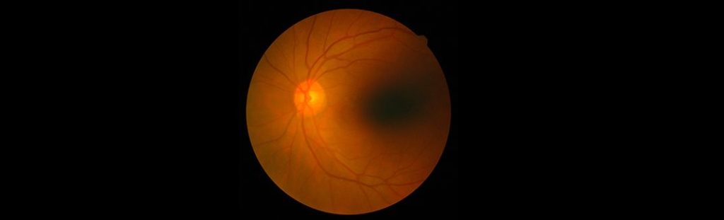 Retinal Detachment – A Flash is all that it takes!