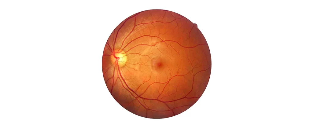 Retinal Detachment Surgery: Diagnosis And Treatment At Centre For Sight