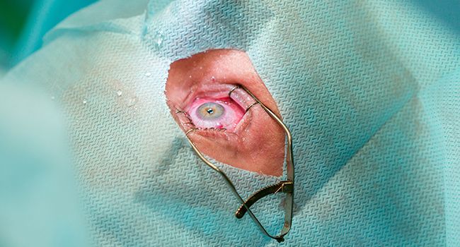 A Glance at Cataract Treatment – Then and Now