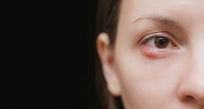 Chalazion: A Common Eye Infection You Might Not Have Heard Of!