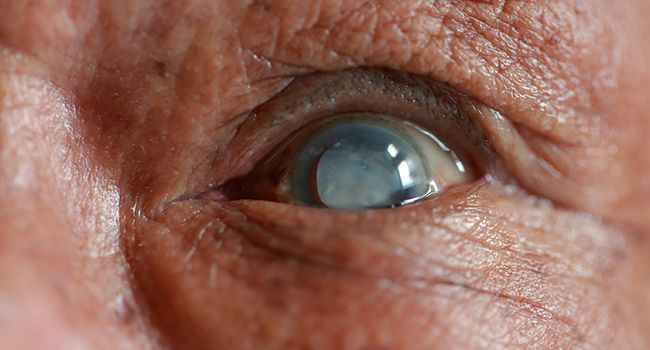Cataract surgery – Things to Keep in Mind