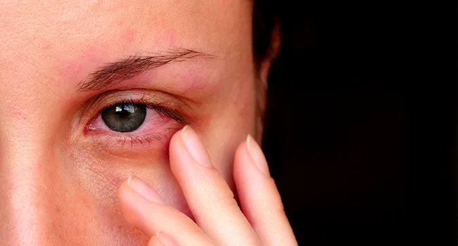 Watery Eyes (Epiphora): Causes, Symptoms, Treatments