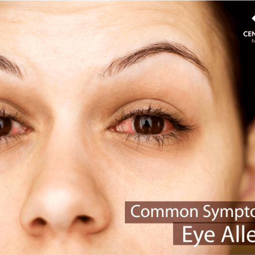 Common Symptoms of Eye allergies