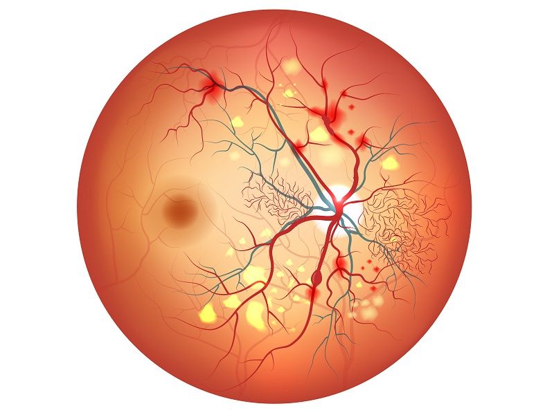 5 Things You Should Know About Diabetic Retinopathy