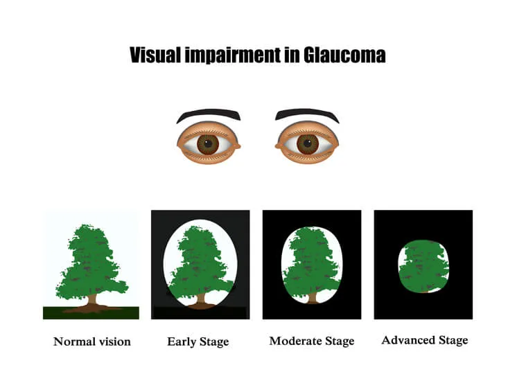 If You Have These Five Symptoms, It Is Glaucoma
