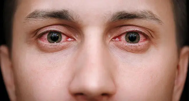Everything You Need To Know About Burning Eyes