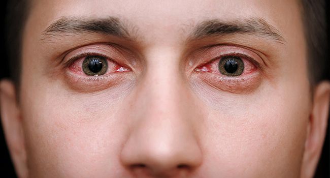 Burning Eyes – Causes, Symptoms & Treatments