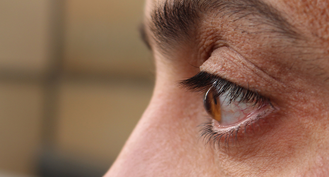 Keratoconus Eye Disorder: Types, Signs, & Treatments