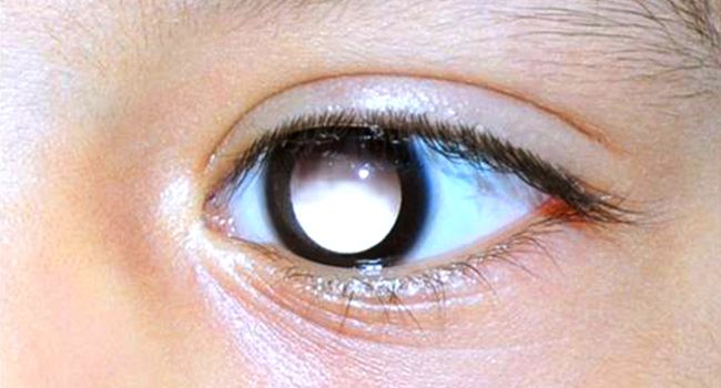 What is Retinoblastoma and Can it be Cured?