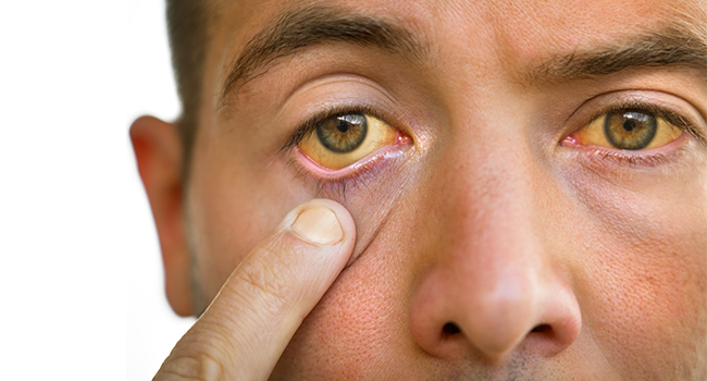 6 Causes of Yellow Eyes & When to See a Doctor