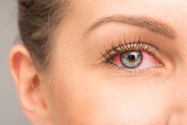 Signs you may be suffering from dry eye syndrome