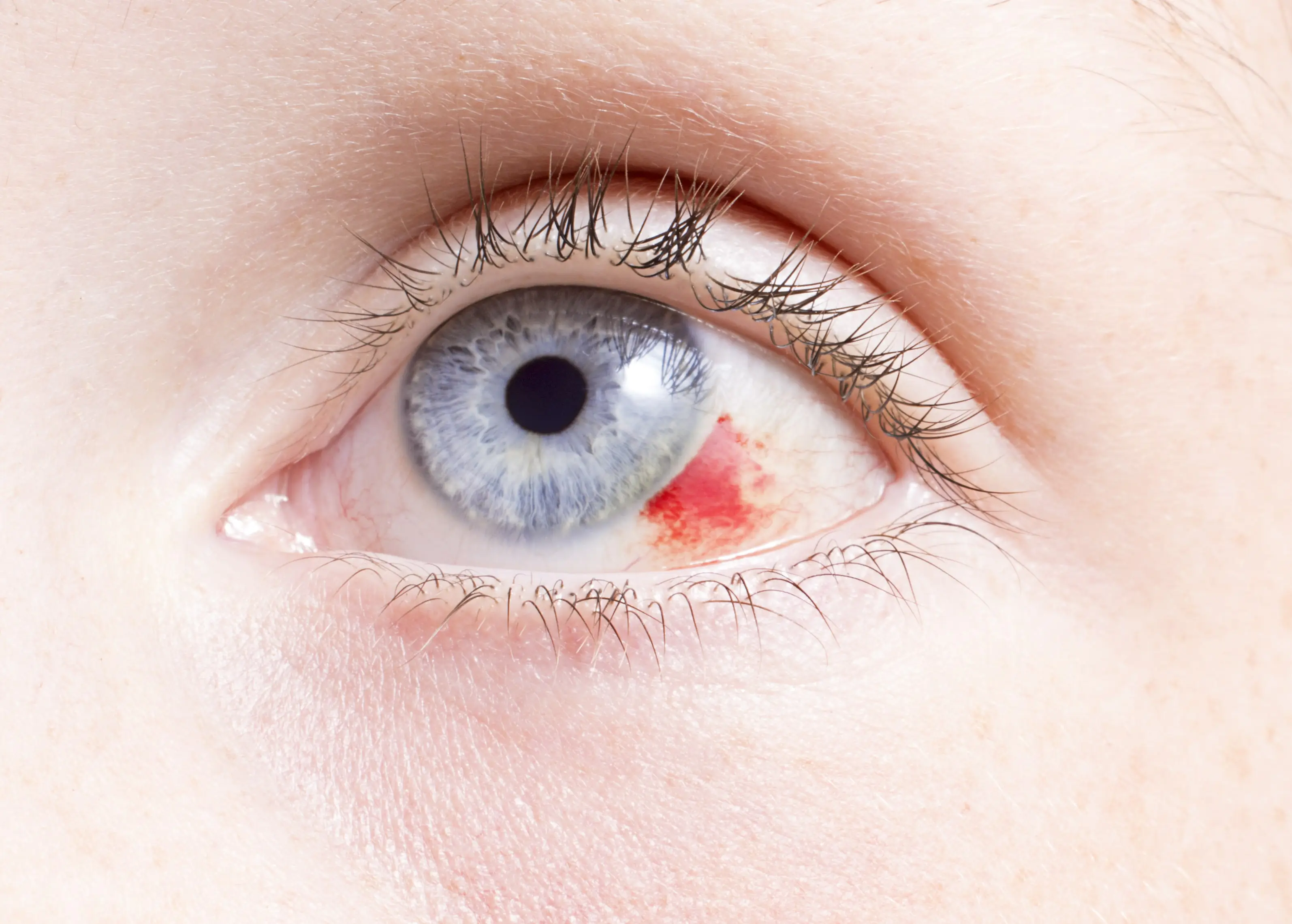 What are the complications of the scratched cornea?