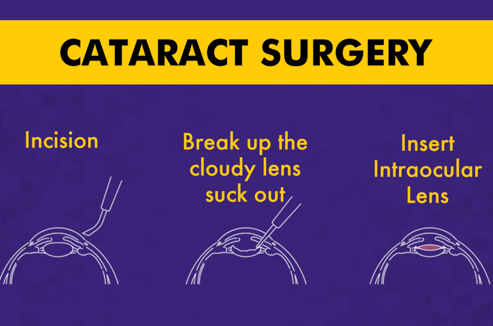 Types of Cataract Treatment